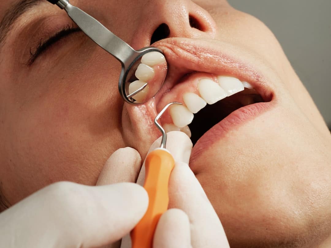 Implanty zębów – jak należy o nie dbać?