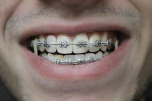 Leczenie ortodontyczne to nie wstyd!